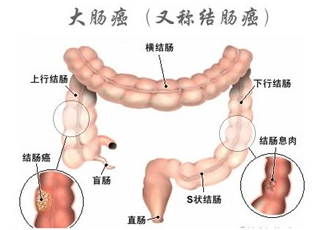 百万网红咖啡背后的选择，放弃直肠癌化疗之路探索