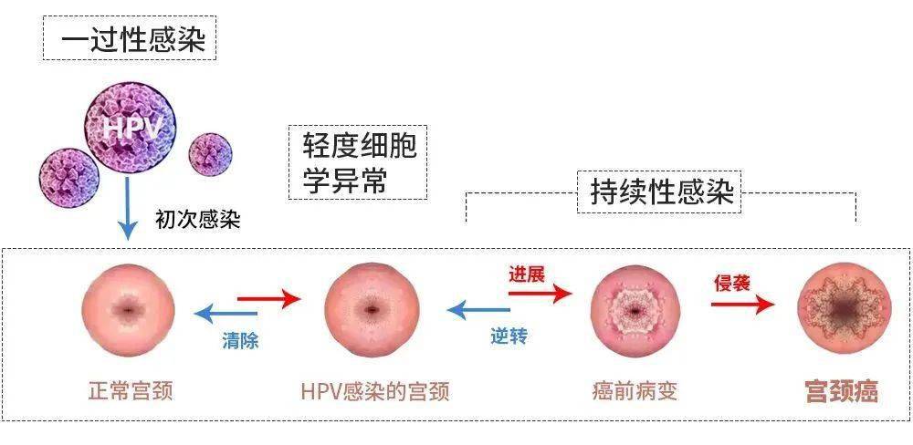 从HPV感染到宫颈癌，五步之遥的警示