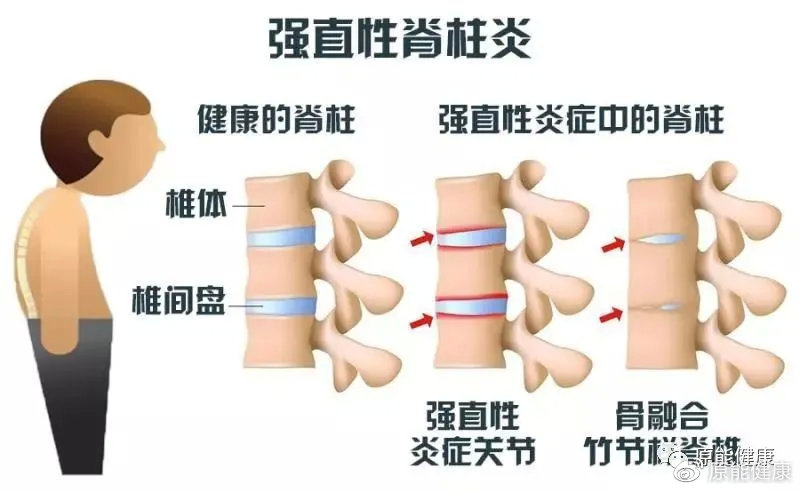 强直性脊柱炎患者求职遭遇的困境与挑战，入职被拒现象探讨