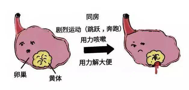 夫妻玩闹引发意外，妻子黄体破裂敲响健康警钟