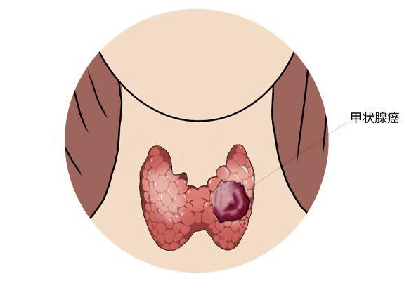 公务员体检中的桥本甲状腺炎，政策调整下的新考量