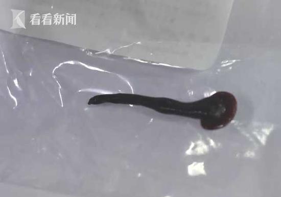 医疗惊险瞬间，7岁孩童雾化治疗意外咳出长达12厘米的蚂蟥