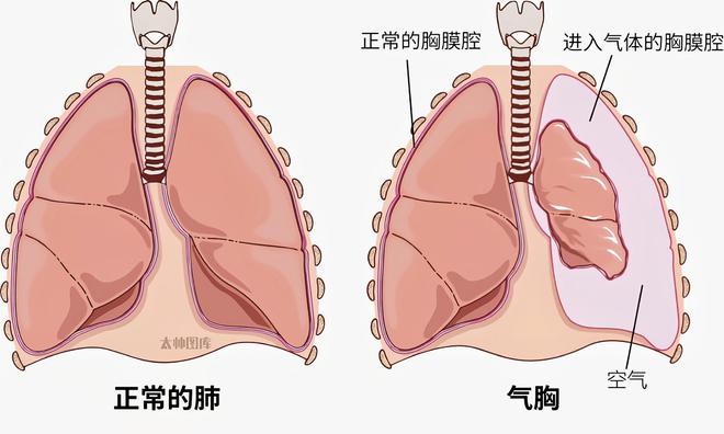 方大同身体状况引关注，气胸影响及预防手段解析