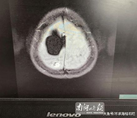 颅内寄生活虫8年 医生追踪半年活捉